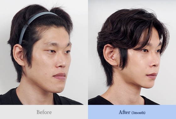 양악 + 턱끝 + 광대