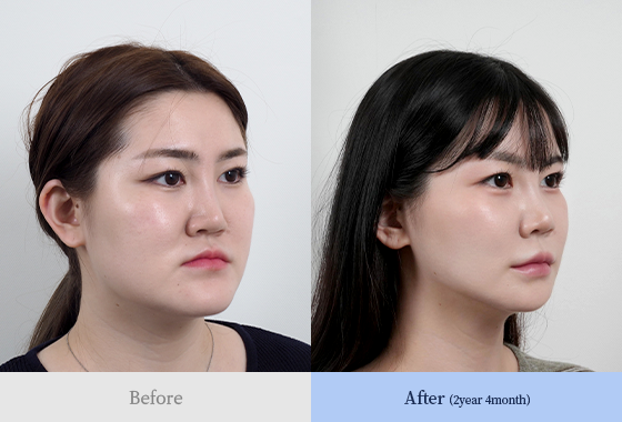 양악 + 턱끝 + 광대